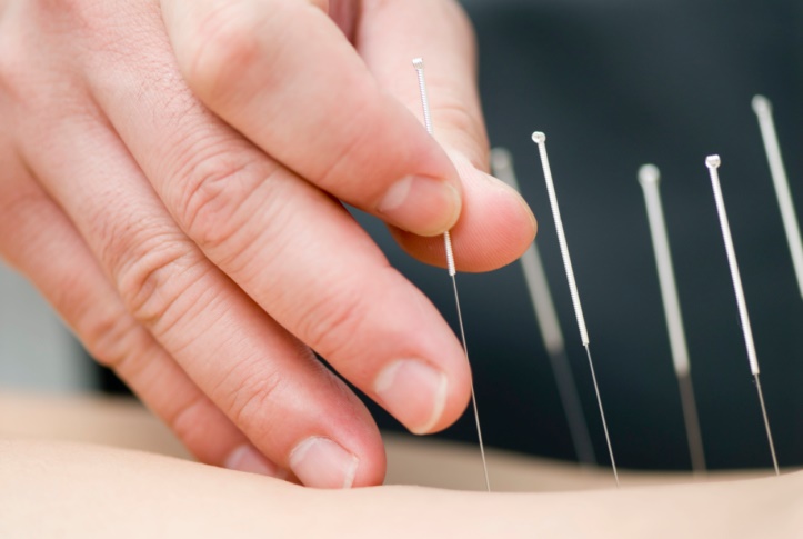 treatment by acupuncture