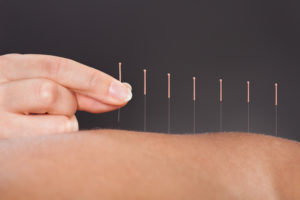 Close up of acupuncture needles lined up in a row.
